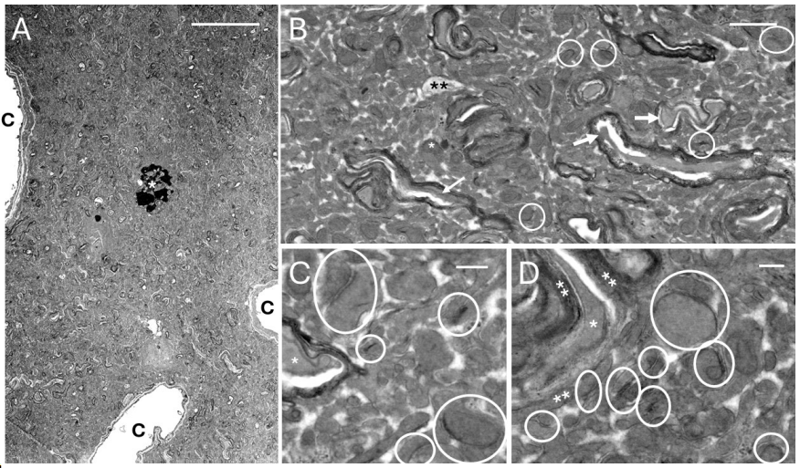 Electron micrographs of a human cryopreservation patient's brain showing identifiable synapses, intact membranes, and no ice damage after years in liquid nitrogen